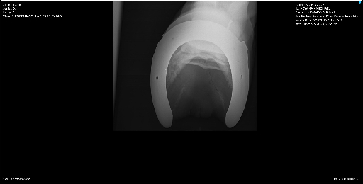 Right Forenavicular PAPR PADIO